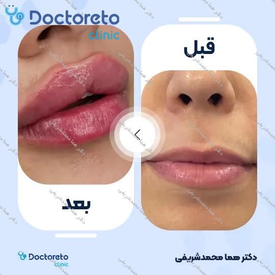 تزریق ژل لب