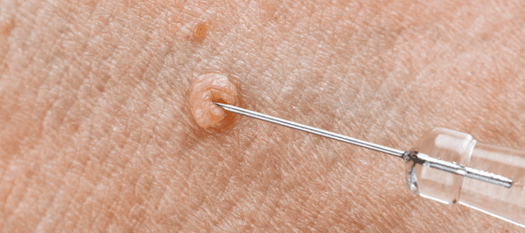 برداشتن زگیل تناسلی (هر جلسه)