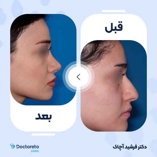 عمل جراحی زیبایی بینی (رینوپلاستی)