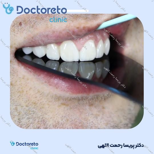 پرکردن دندان اطفال