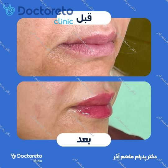 تزریق ژل لب