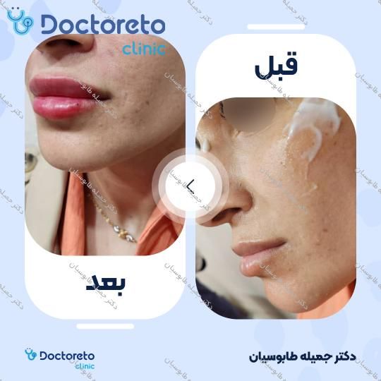 تزریق ژل لب