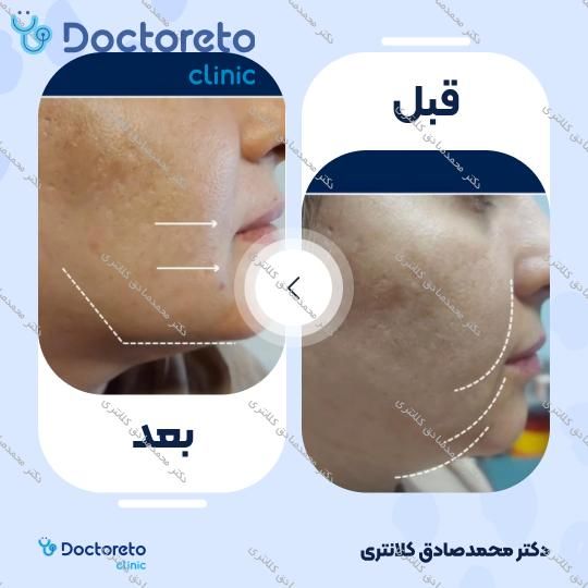 تزریق ژل زاویه فک