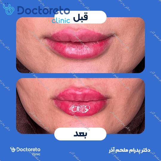 تزریق ژل لب