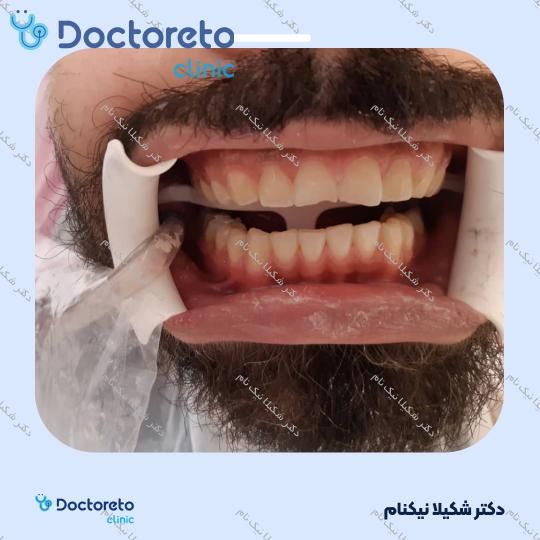 بلیچینگ دندان (سفید کردن دندان)