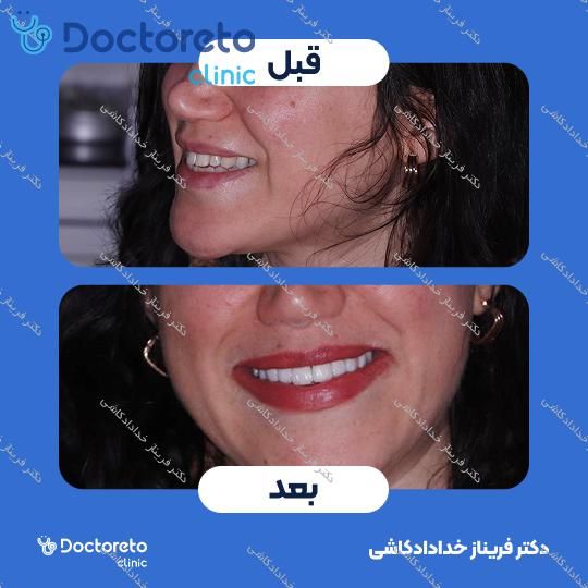 ونیر کامپوریت (هر واحد)