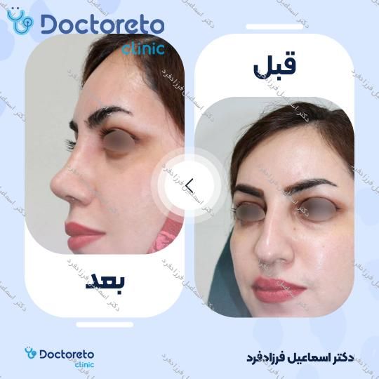 عمل جراحی مجدد زیبایی بینی (رینوپلاستی)