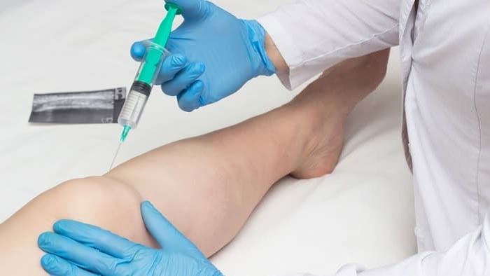 تعویض مفصل به روش جراحی