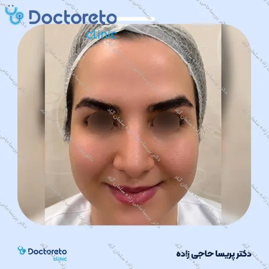 تزریق بوتاکس صورت (پیشانی، خط اخم، پنجه کلاغی)