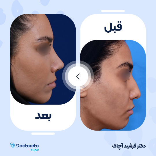 عمل جراحی ترمیمی زیبایی بینی (رینوپلاستی)