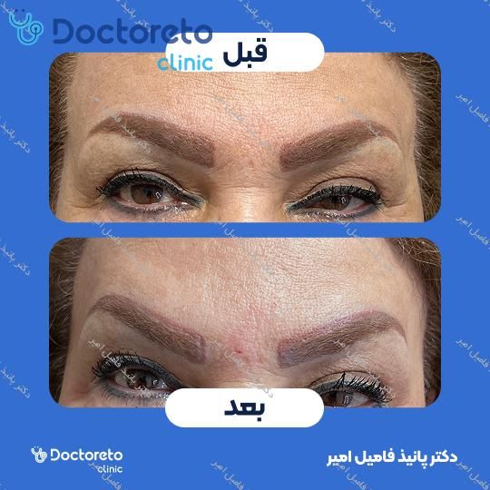 تزریق بوتاکس صورت (پیشانی، خط اخم، پنجه کلاغی)💉