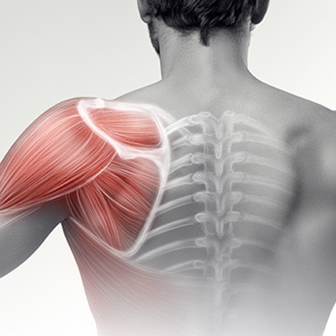 درمان درد شانه به روش پرولوتراپی، اوزون تراپی و بازسازی تاندون