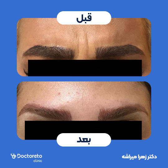تزریق بوتاکس صورت (پیشانی، خط اخم، پنجه کلاغی)💉