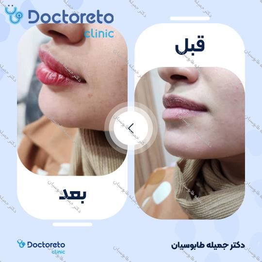 تزریق ژل لب