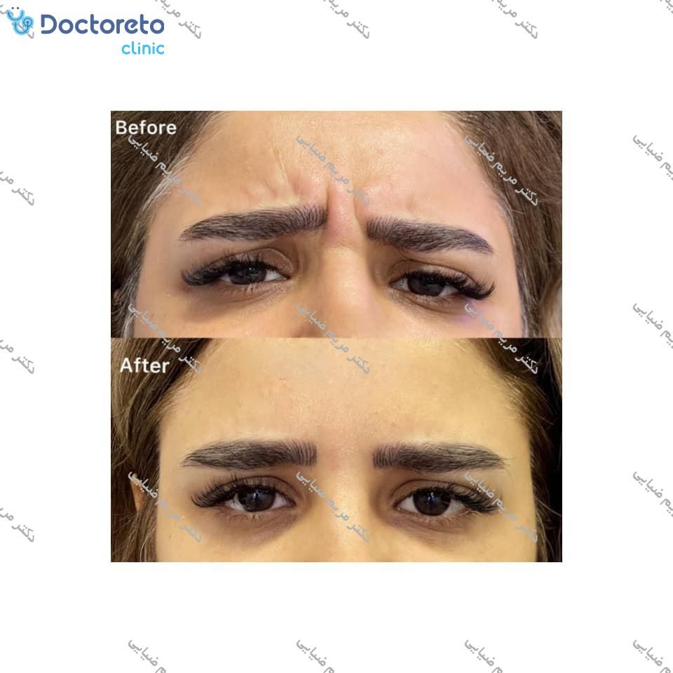 تزریق بوتاکس صورت (پیشانی، خط اخم، پنجه کلاغی)💉