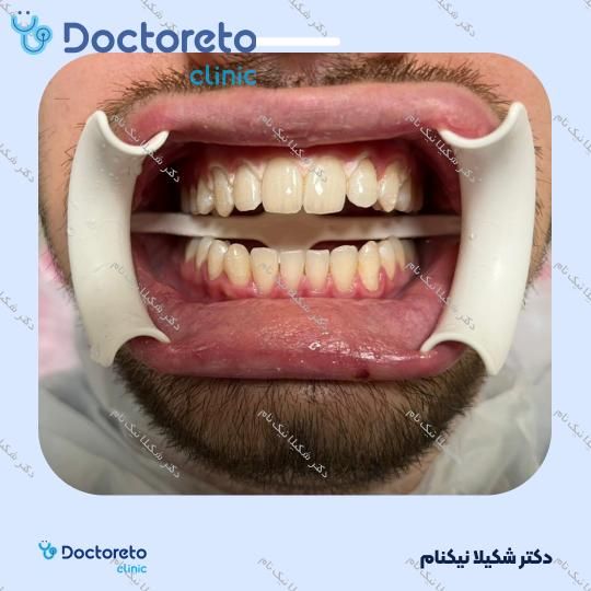 بلیچینگ دندان (سفید کردن دندان)