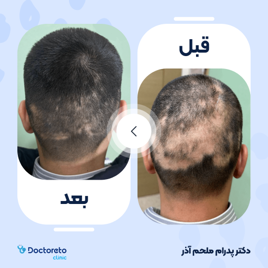 تزریق مزوتراپی مو جهت قطع ریزش مو