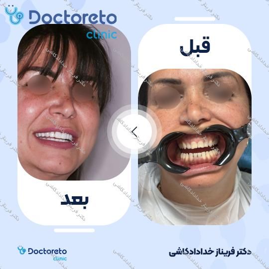 ونیر کامپوریت (هر واحد)