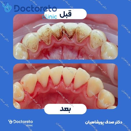جرم گیری کامل دندان‌های دو فک با بروساژ