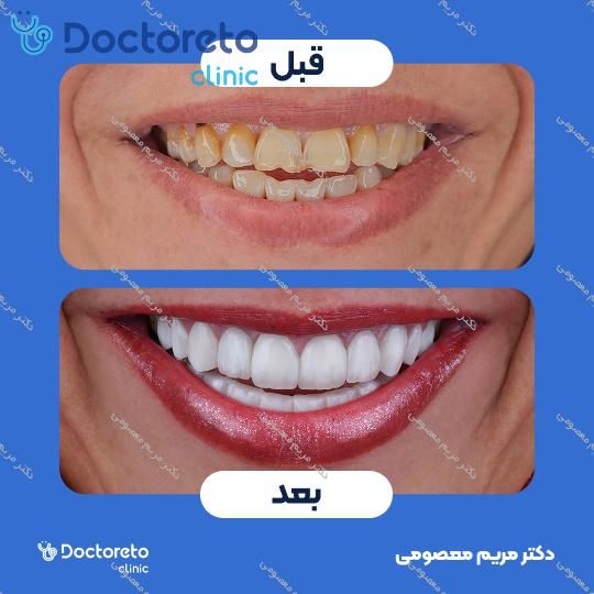 جرم گیری کامل دندان‌های دو فک با بروساژ