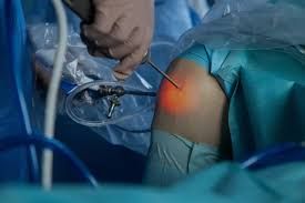 بازسازی رباط صلیبی مفصل به روش آرتروسکوپی