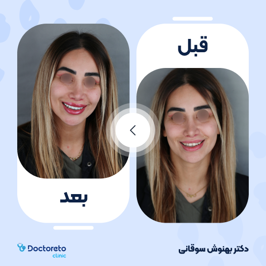 ونیر کامپوزیت (هر واحد)