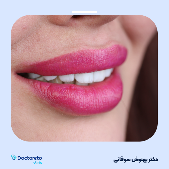 جرم گیری دندان با بروساژ