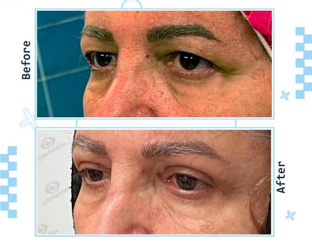 جراحی بلفاروپلاستی پلک بالا