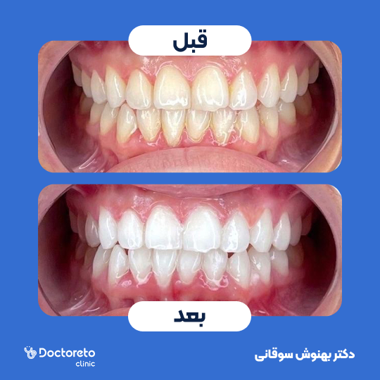 بلیچینگ دندان (سفید کردن دندان)