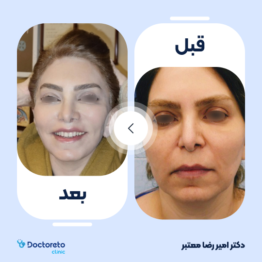 بلفاروپلاستی به روش جراحی