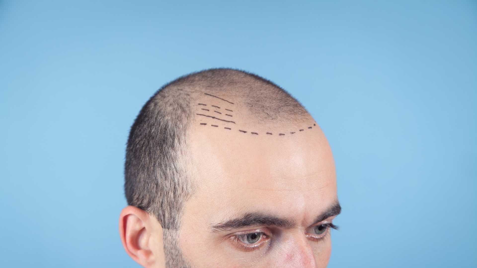 کاشت مو به روش میکرو ایمپلنت