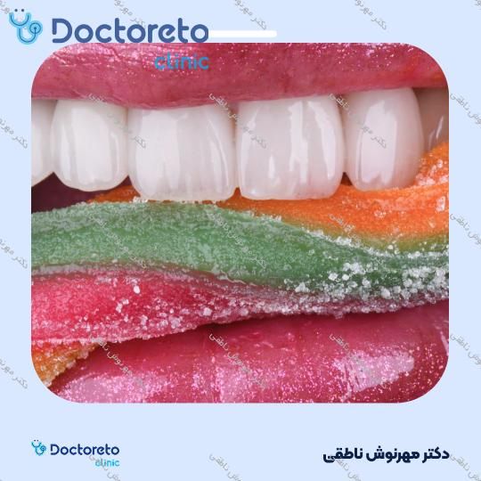 لمینت دندان (هر واحد)