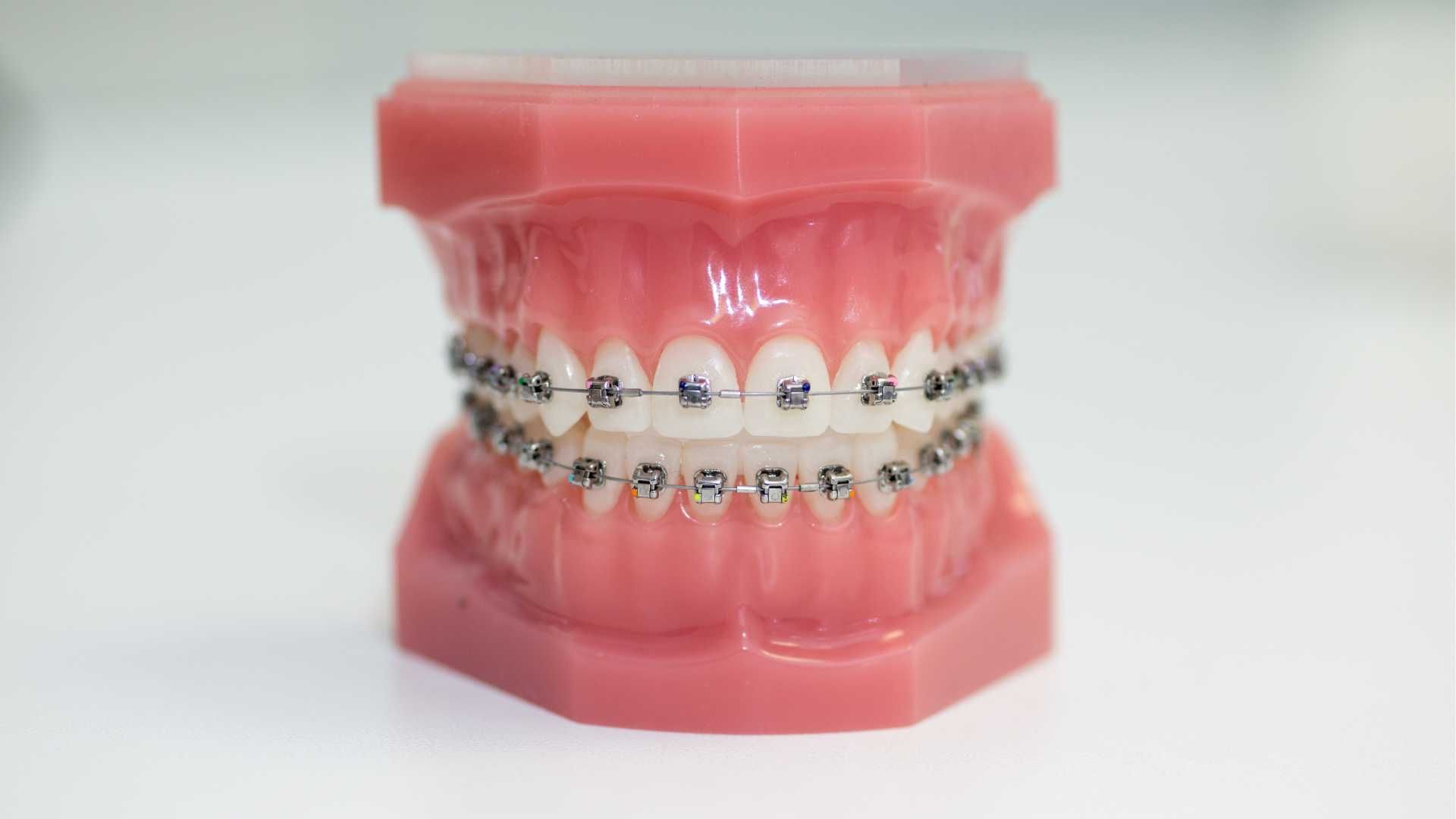 ارتودنسی متحرک (کودکان)