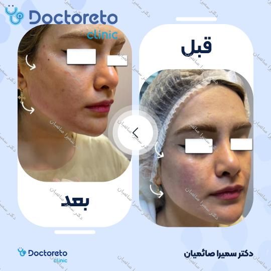 تزریق ژل زاویه فک