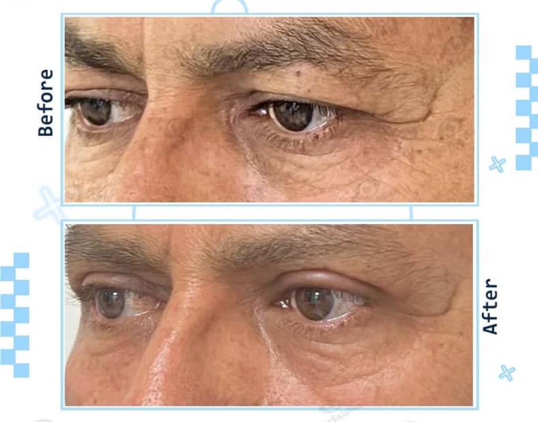 بلفاروپلاستی پلک‌های پایین به روش داخلی