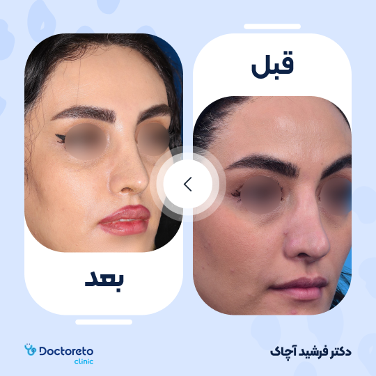 عمل جراحی ترمیمی زیبایی بینی (رینوپلاستی)