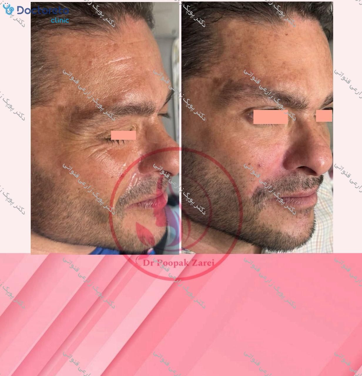 تزریق بوتاکس صورت (پیشانی، خط اخم، پنجه کلاغی)💉