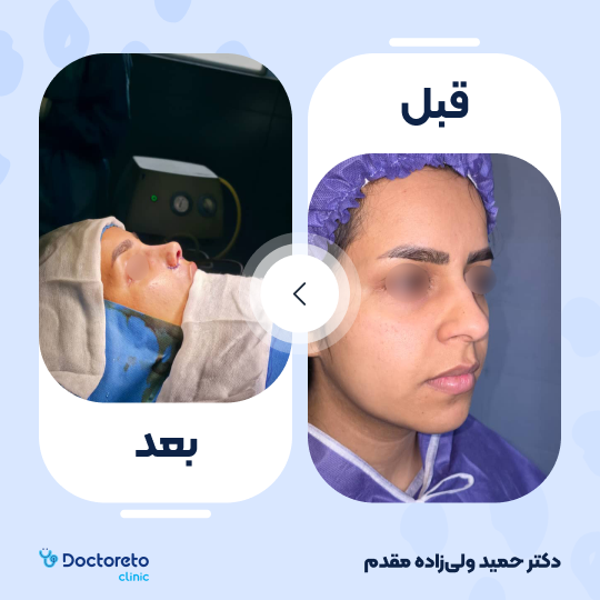 عمل زیبایی بینی گوشتی(رینوپلاستی)