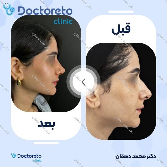 عمل جراحی مجدد بینی (رینوپلاستی)