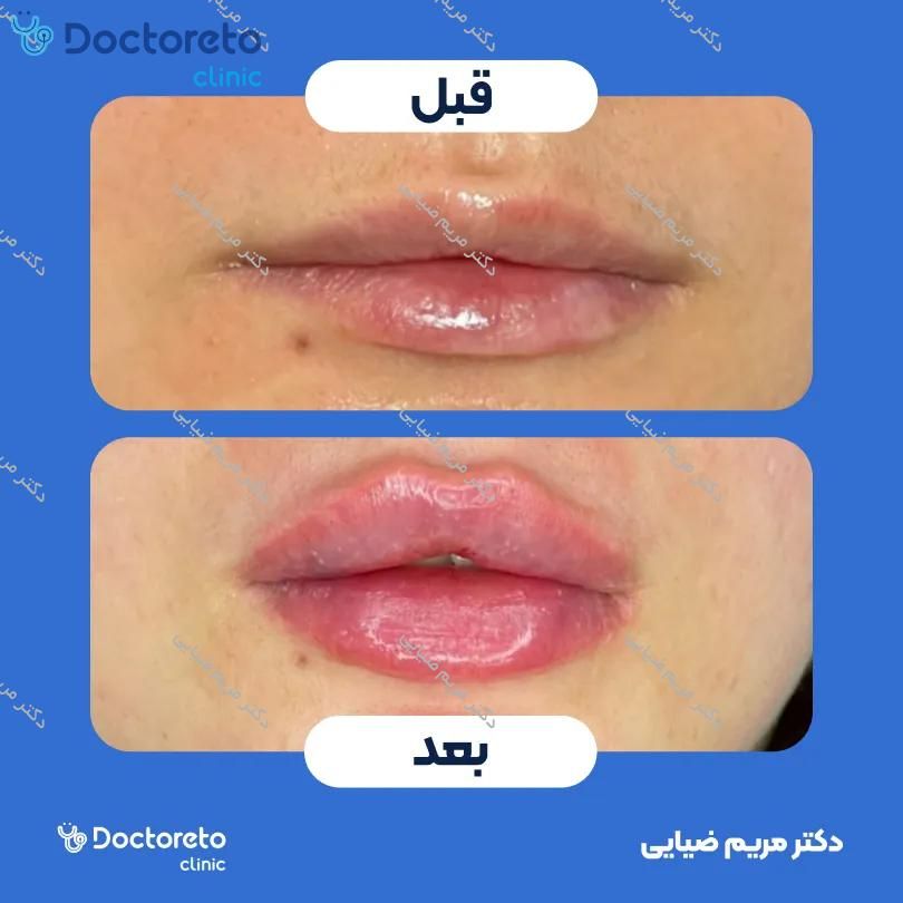 تزریق ژل لب