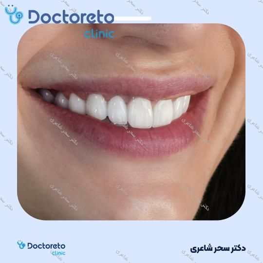 روکش دندان (هر واحد)