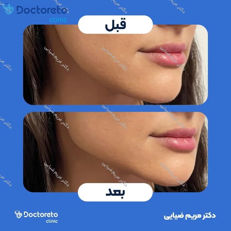 تزریق ژل زاویه فک