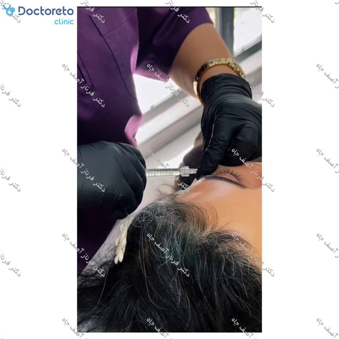 تزریق بوتاکس صورت (پیشانی، خط اخم، پنجه کلاغی)