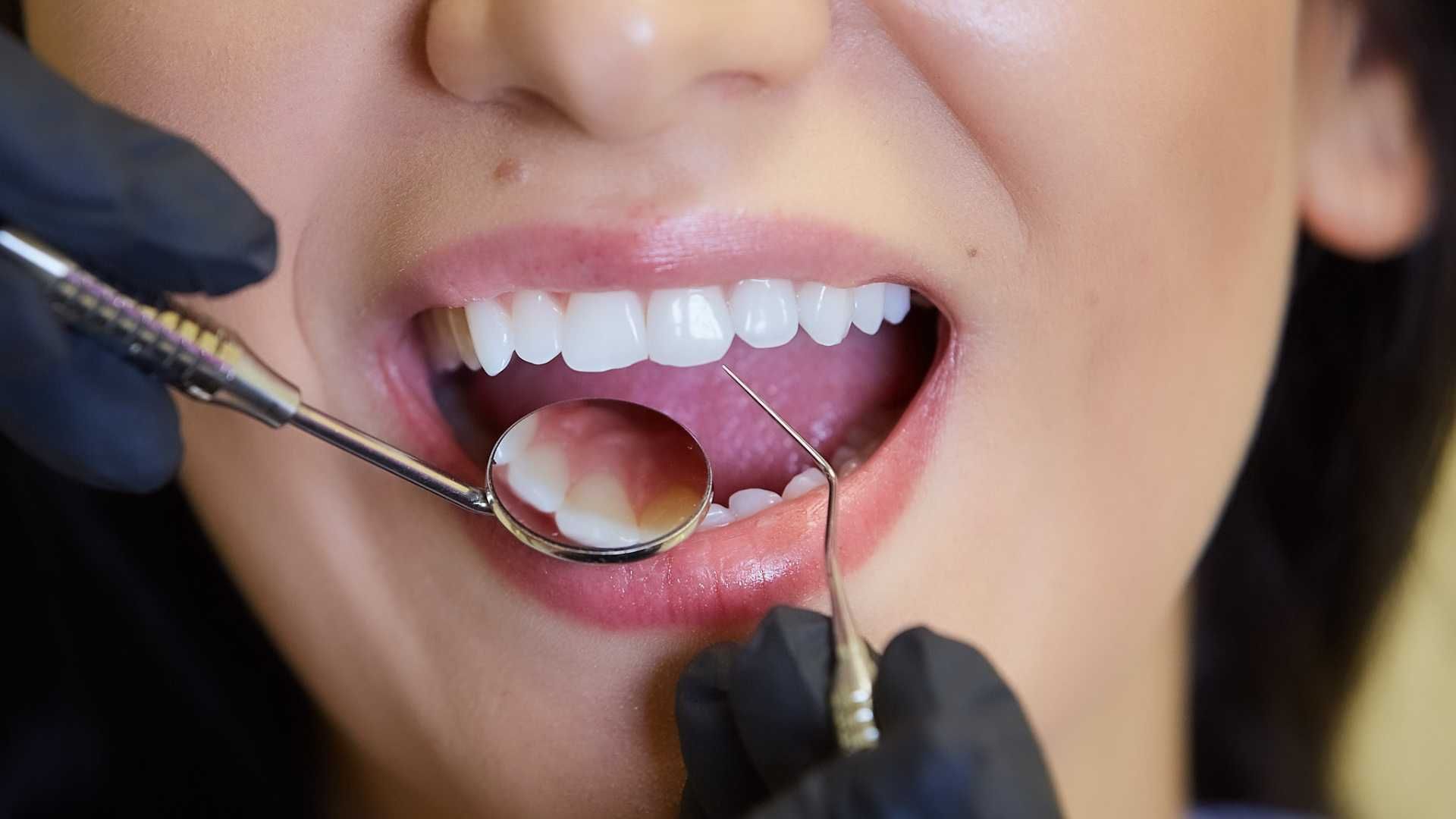 ونیر کامپوزیت (هر واحد)