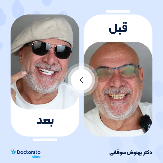 ونیر کامپوزیت (هر واحد)