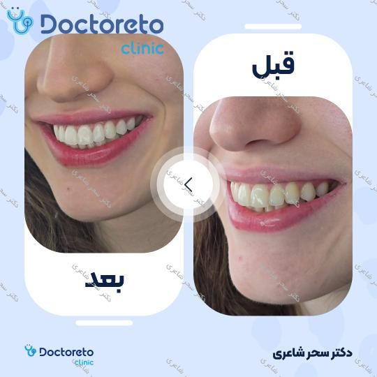 بلیچینگ دندان (سفید کردن دندان)