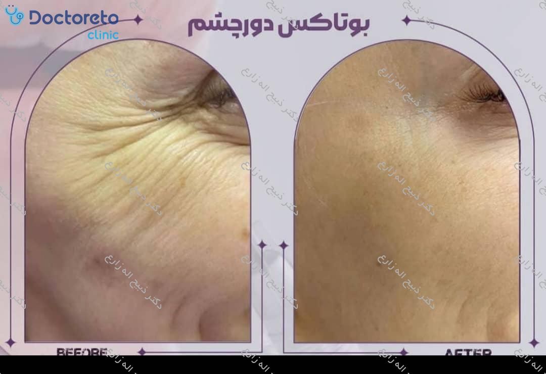 تزریق بوتاکس صورت (پیشانی، خط اخم، پنجه کلاغی)💉