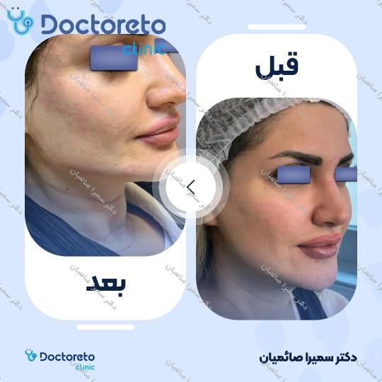 تزریق ژل زاویه فک