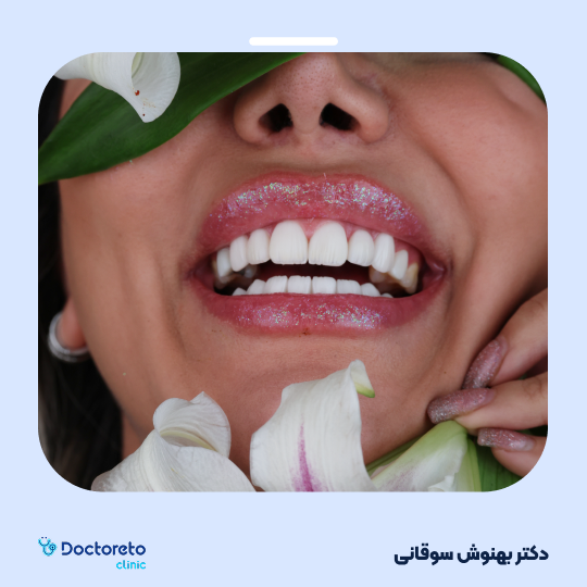 لمینت دندان با برند آی پی اس ایمکس (هر واحد)