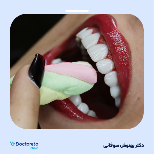 بلیچینگ دندان (سفید کردن دندان)